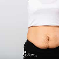 Tummy Tuck in Mexico vs USA - How American Moms Are Avoiding $12,000 Surgical Bills